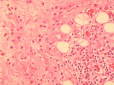 Fig. 1A: 	Low power view of section of right parotid mass showing dense eosinophilic infiltration within the nodal parenchymal and fibroadipose tissue. (x 20 magnification; Haematoxylin & Eosin stain).